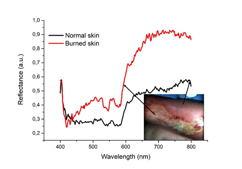 利用高光谱成像评估皮肤烧伤深度